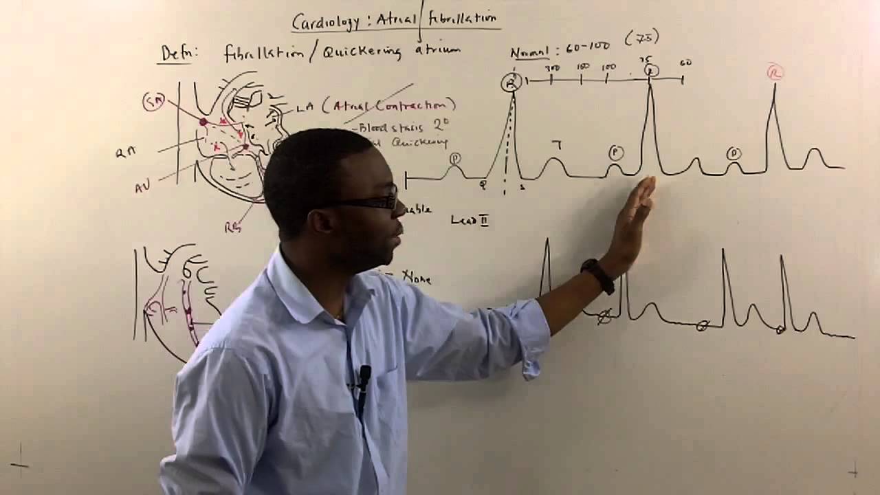 Atrial Fibrillation made simple Part 2