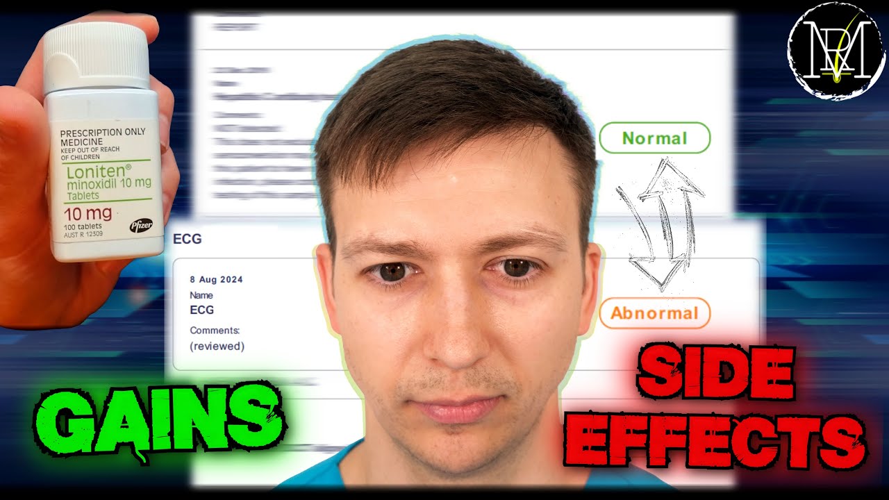 Oral Minoxidil After 3 Years : Test Results REVEALED