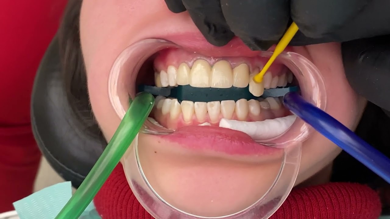 Yaprak Diş Kaplama (Laminate Veneers) Nasıl Yaplılır? Nişantaşı DentNis Diş Kliniği