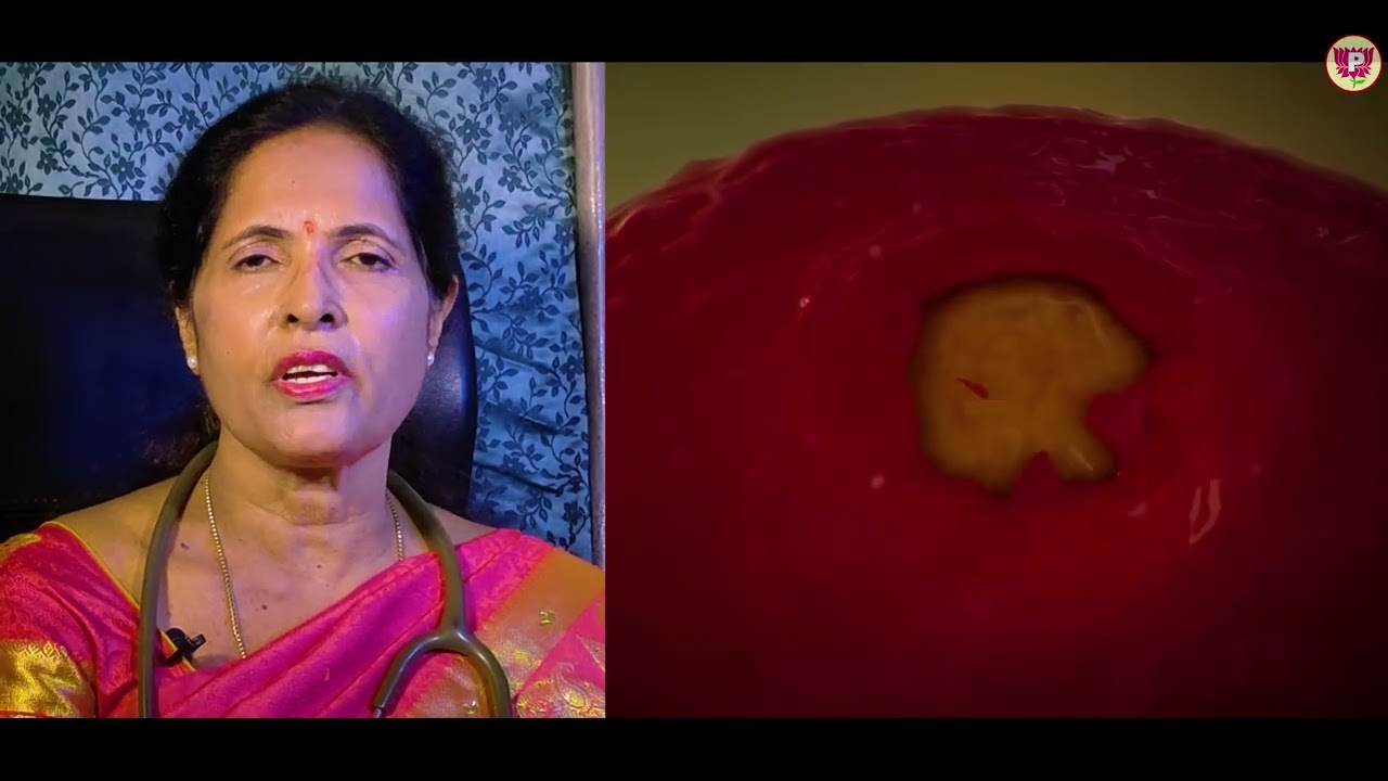 EPISODE_05 || PCOD Polycystic Ovarian Disease