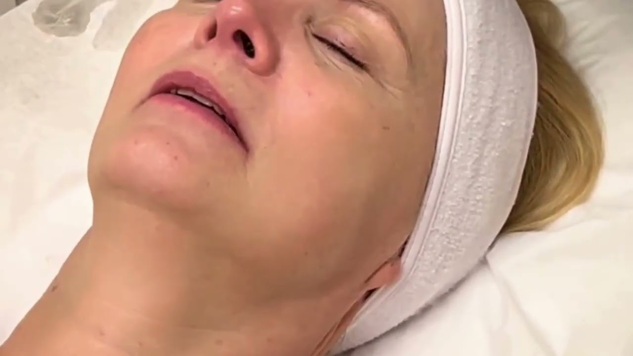 I Tried Sofwave at Treat Medspa Non Surgical Face Lift Results