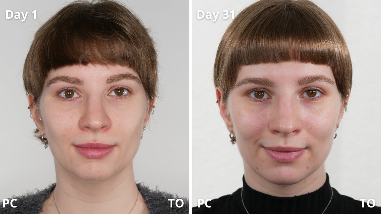 Paula's Choice Azelaic Acid vs The Ordinary Review | 31 Days Results With Pictures