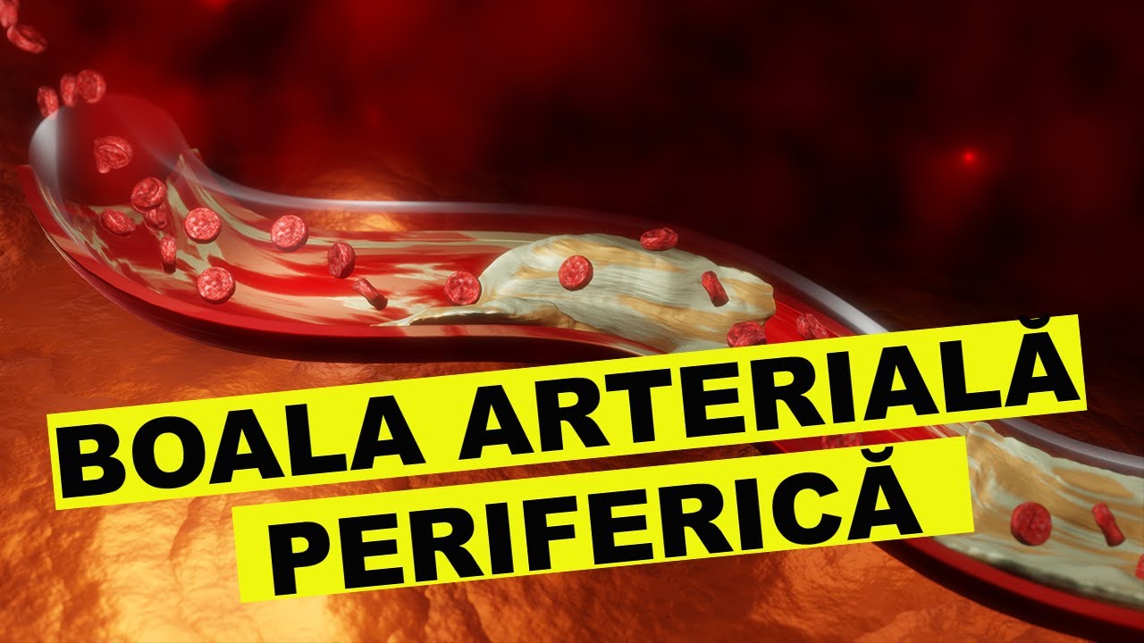 Boala arterială periferică: diagnostic și tratament