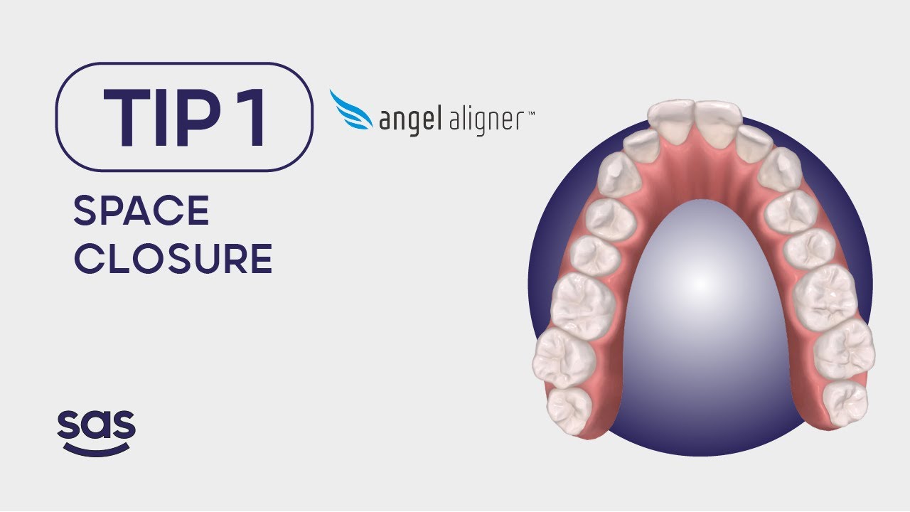 Tip 1. Angel Aligner - Space closure