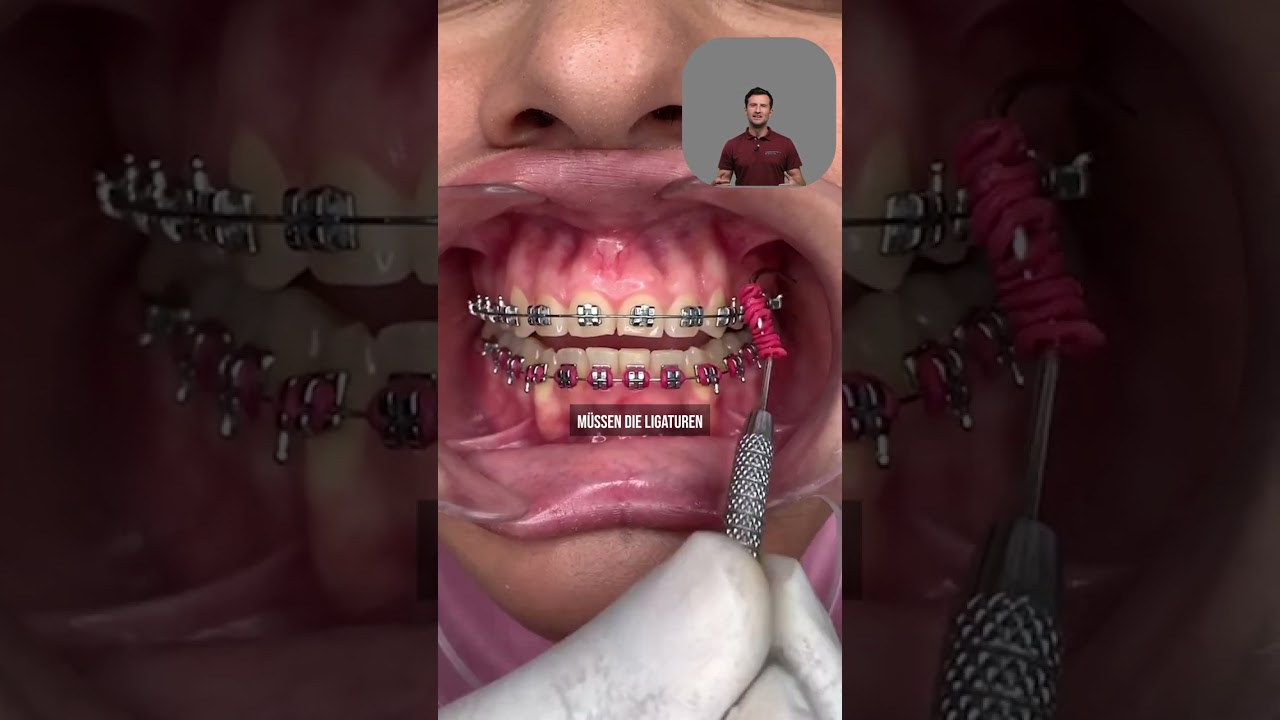 Das passiert bei einer Zahnspangen-Kontrolle mit Brackets. #shorts