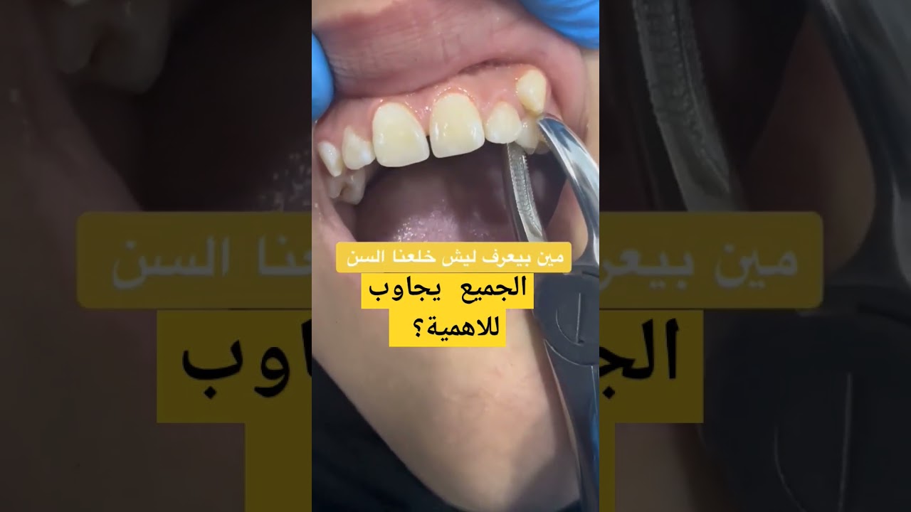 خلع الاسنان بطريقة سريعة||خلع الانياب #طبيبة_اسنان #دكتور_اسنان #دكتورعبدالله_سلطان #dentist #teeth