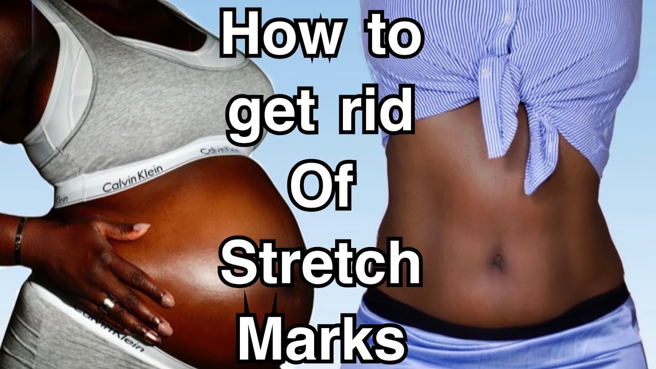 HOW TO PREVENT AND REMOVE STRETCH MARKS!!!!!!! | Fumi Desalu-Vold