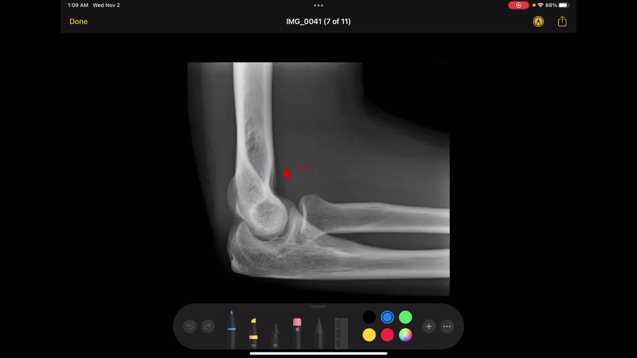 Image Evaluation of the Elbow