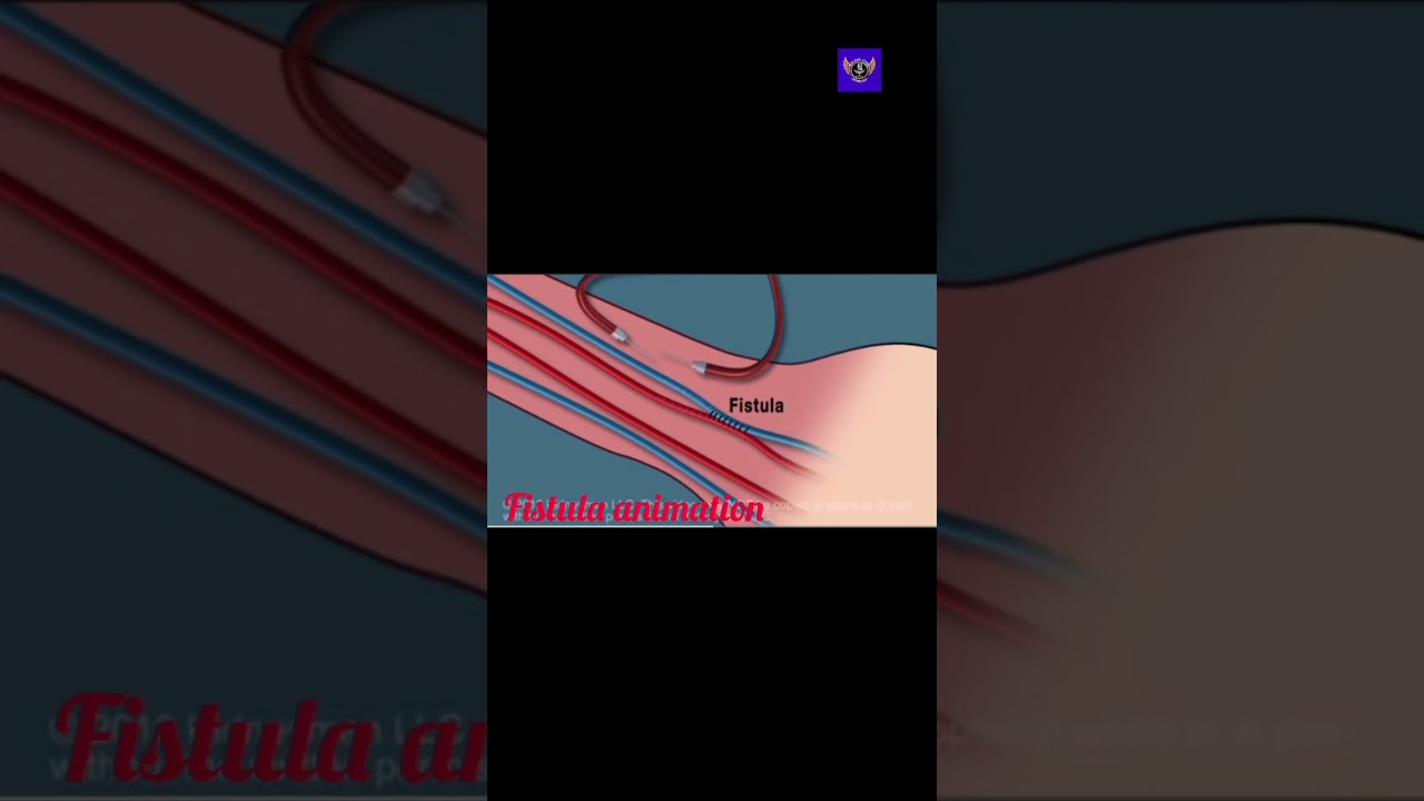 Dialysis fistula animation #dialysis #medical #hemodialysis
