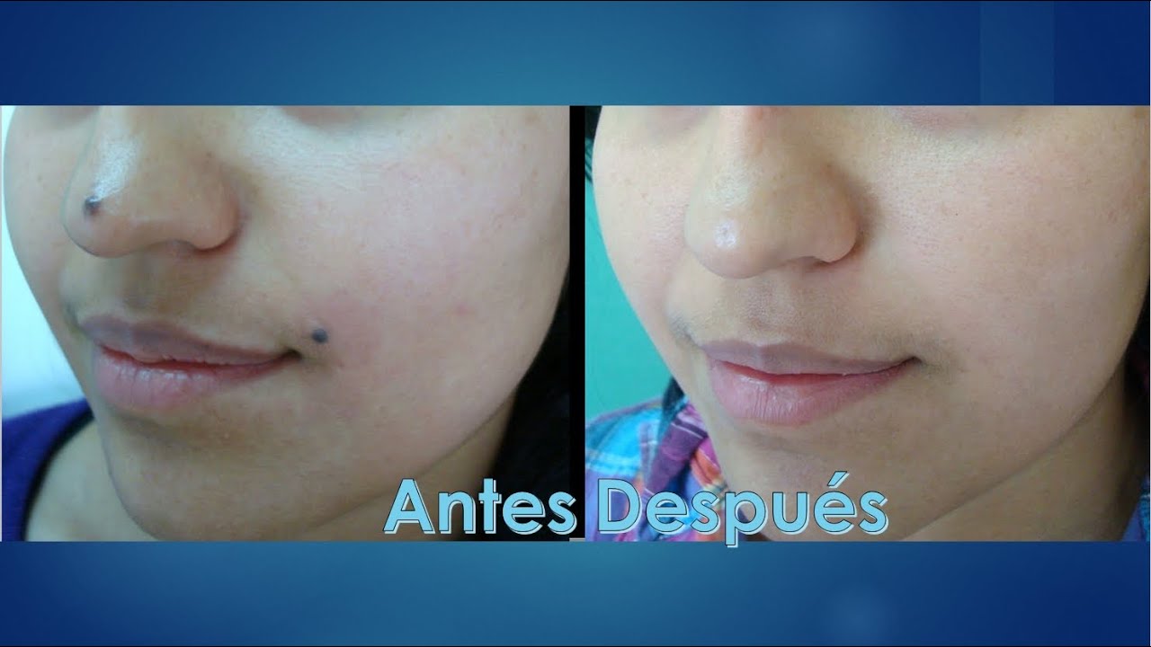 Remocion de Lunares en todo el cuerpo con Laser - 7 casos con fotos de antes y despues