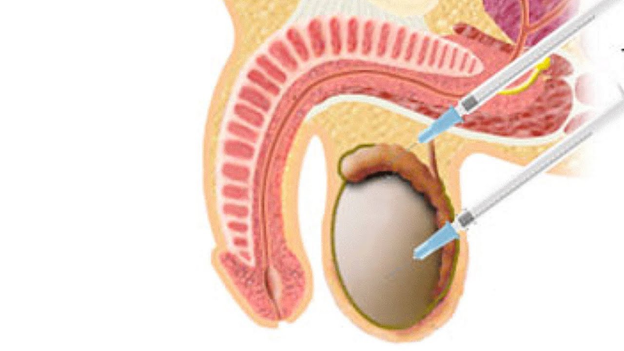 Techniques for Surgical Sperm Retrieval-Dr. Sathya Balasubramanyam of Cloudnine Hospitals