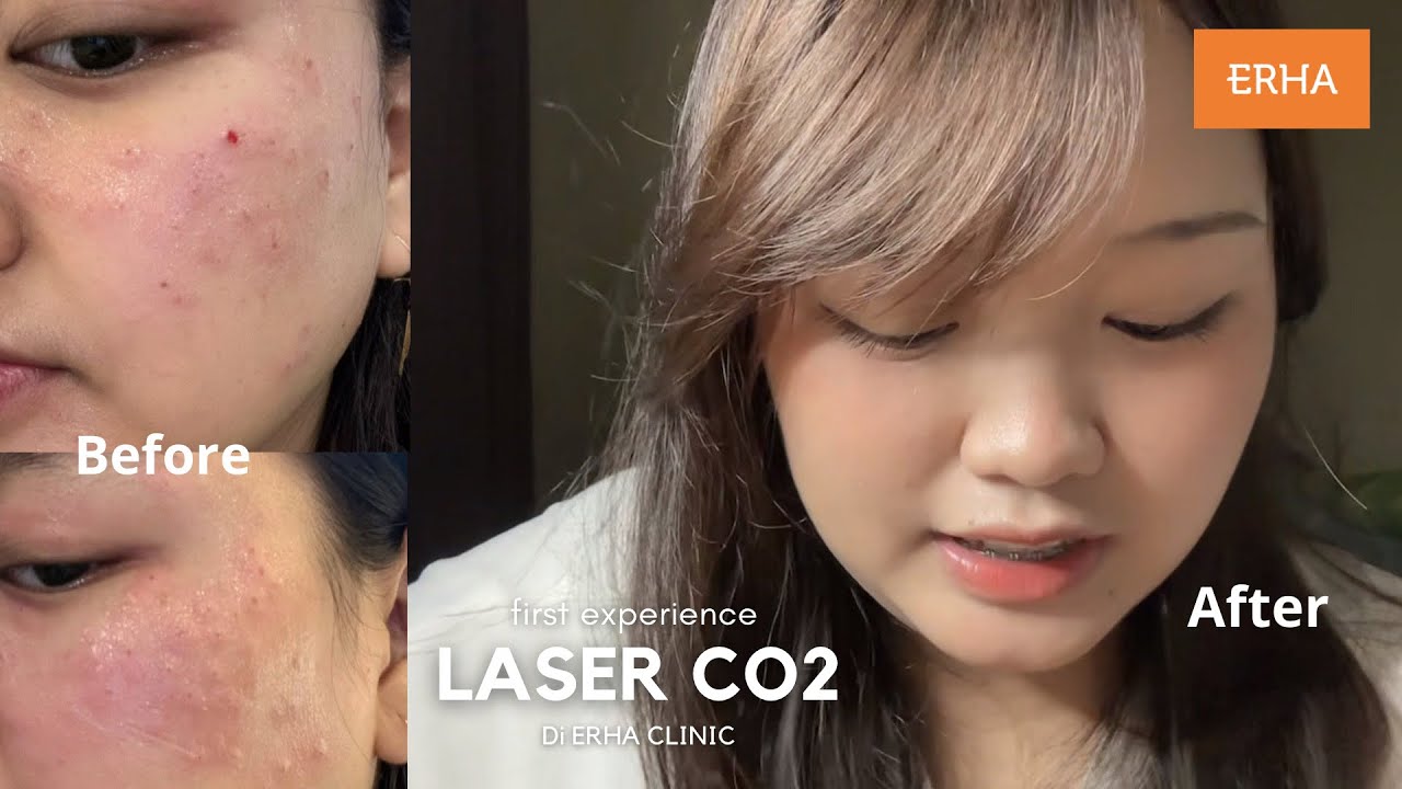 Me Time💆🏻‍♀️: Treatment laser co2 untuk keratosis di Erha Clinic‼️SKIN TAG, BINTIK HITAM HILANG