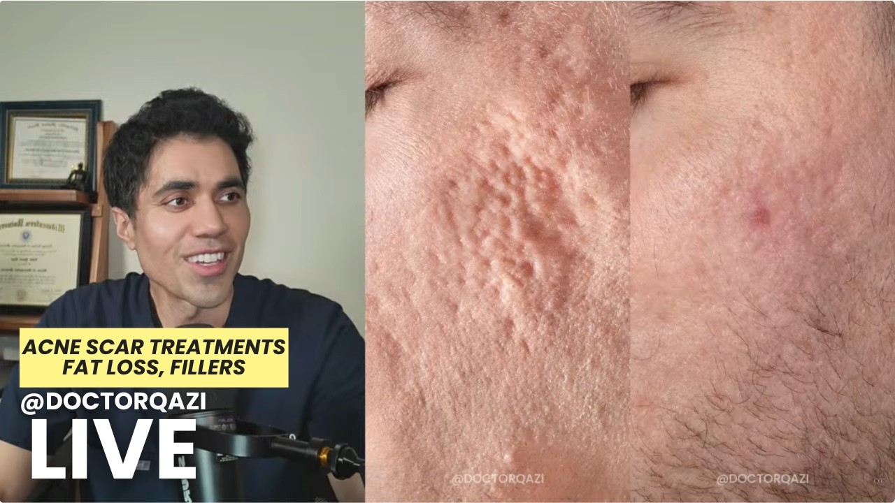 Dr. Qazi discusses Acne Scar Treatments, Fat Loss, Fillers | Dr. Qazi Unsponsored Live | 2.17.2026