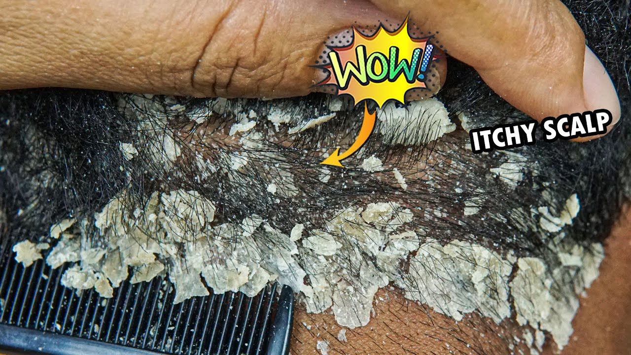 Psoriasis Scalp Scratching Big Flakes #943