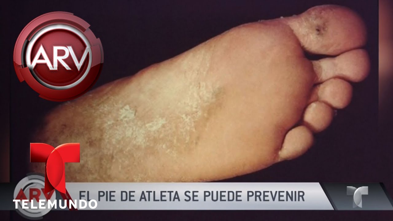 Remedios para combatir el pie de atleta | Al Rojo Vivo | Telemundo