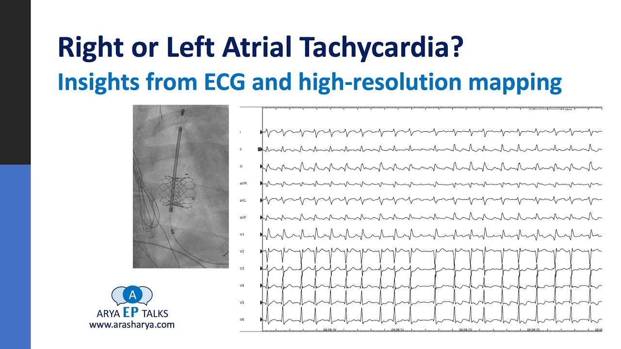 Right or left atrial tachycardia?