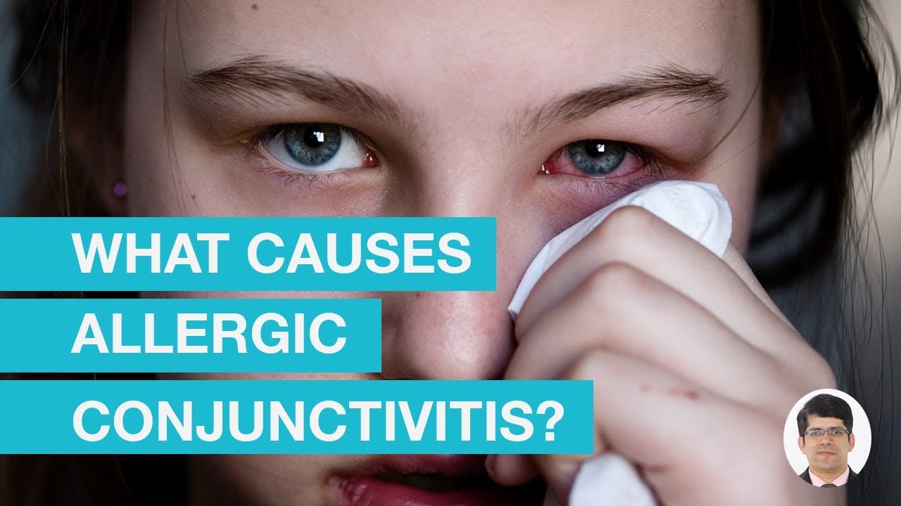 What Causes Allergic Conjunctivitis?
