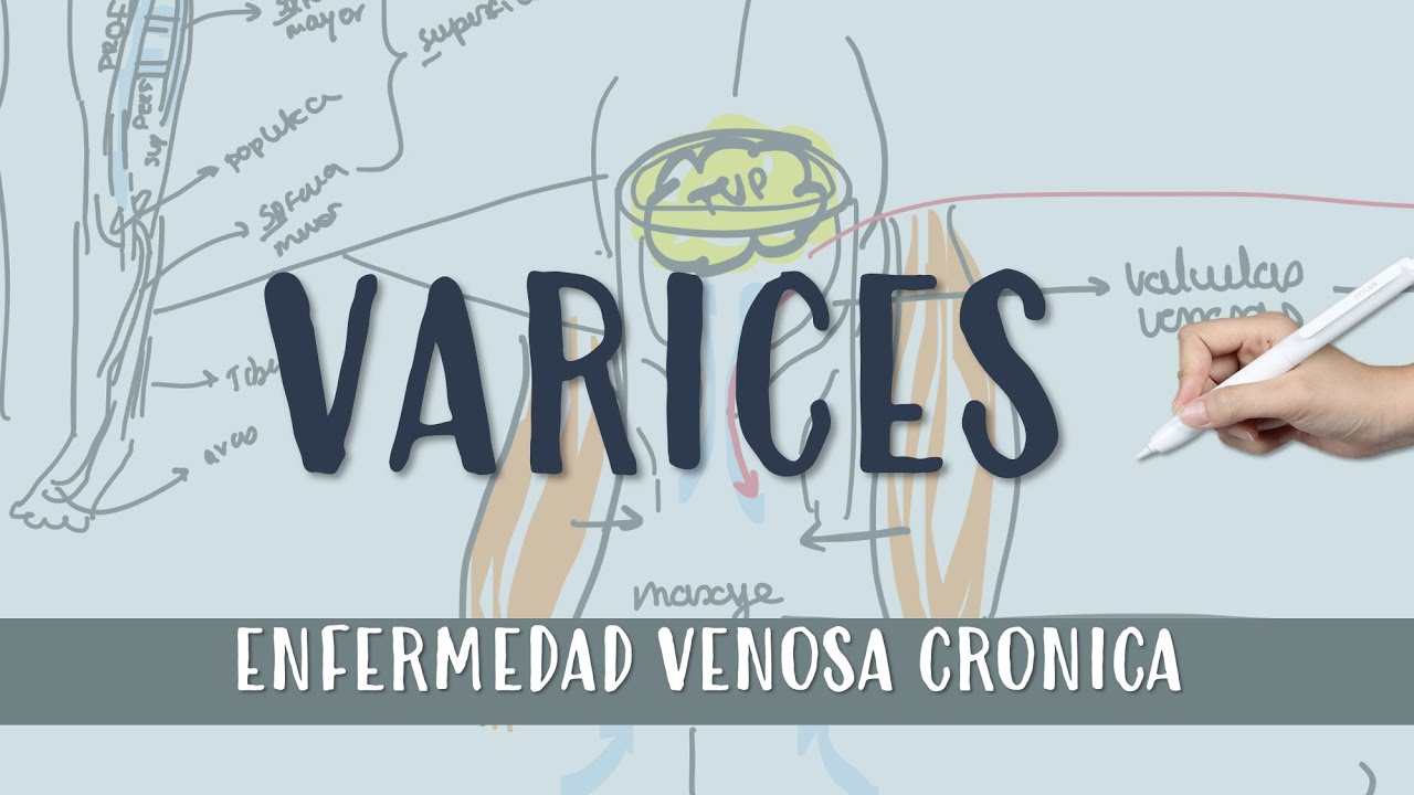 VARICES !! #Flebitis #varices : ENFERMEDAD VENOSA CRONICA