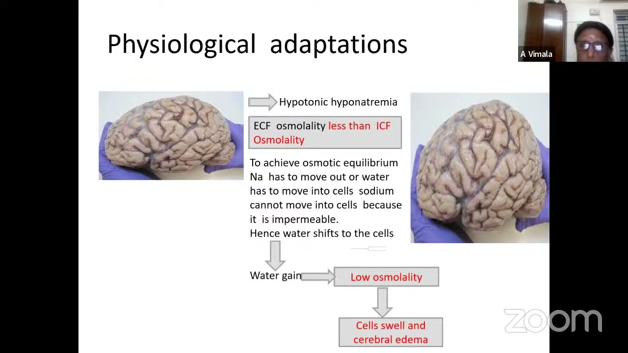 Hyponatremia