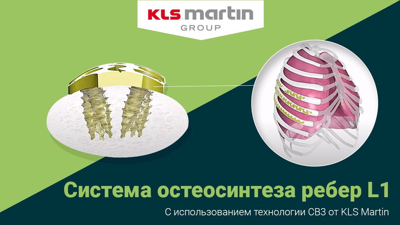 Система остеосинтеза ребер L1 с использованием технологии CB3 от KLS Martin