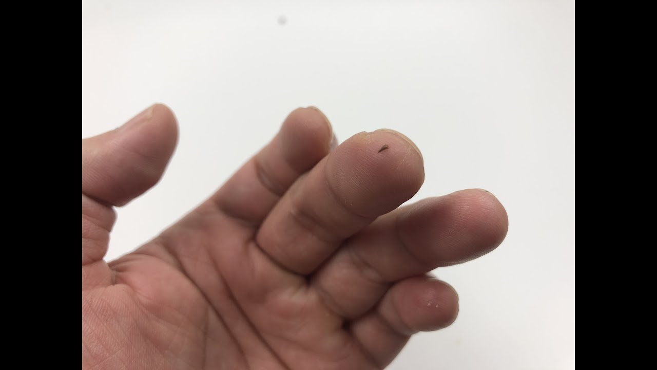 被刺扎用针挑不出来怎么办？教你一招不用挑，让刺儿自己蹦出来