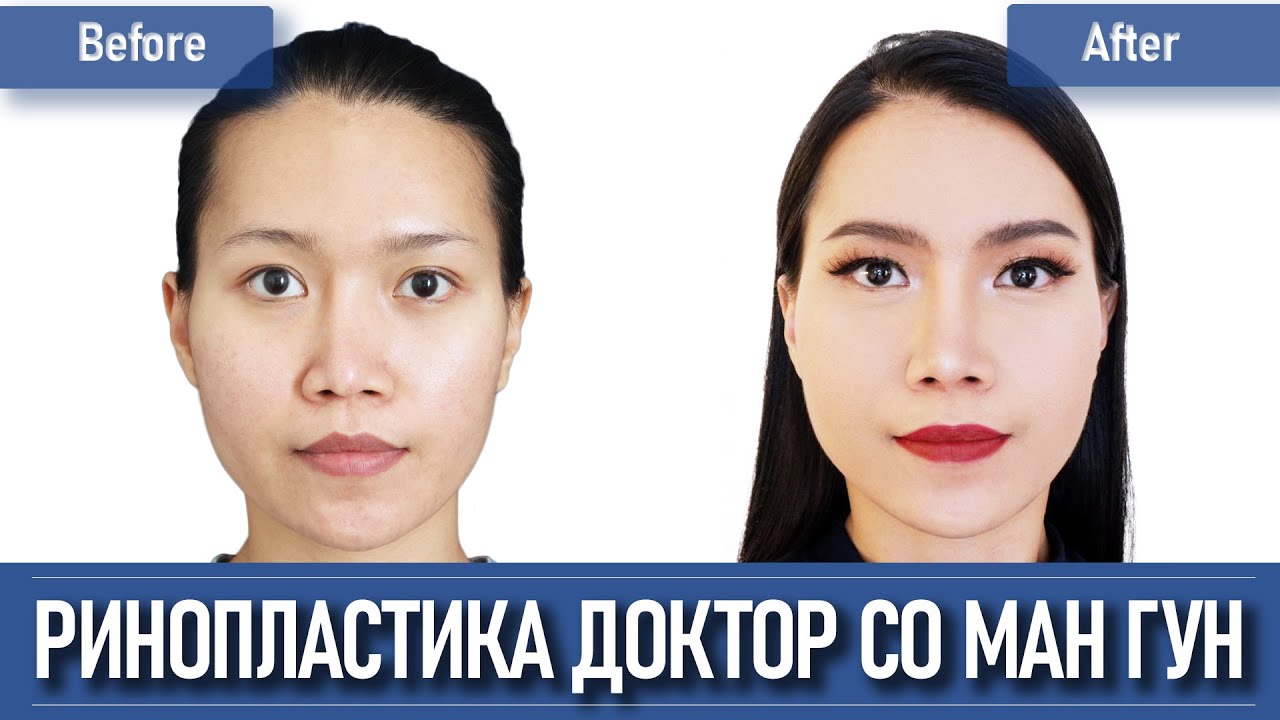 Ринопластика в Корее доктор Со Ман Гун