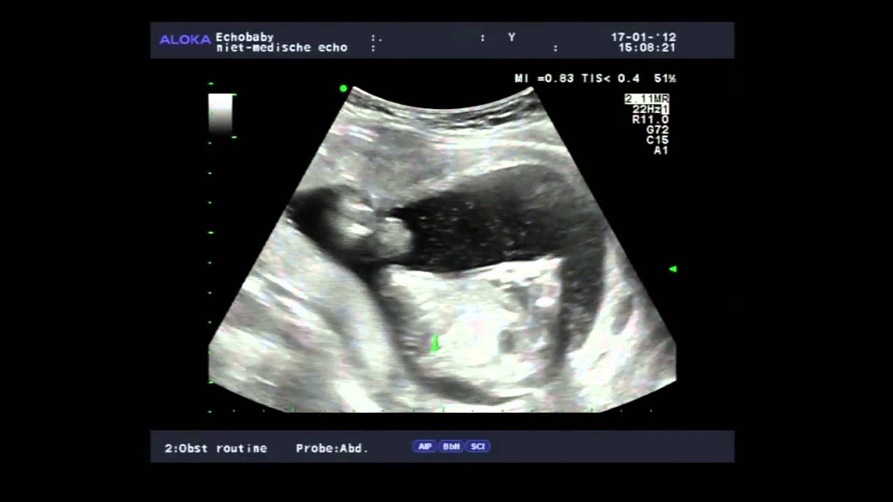 2D en 3D-echo 20 weken zwanger