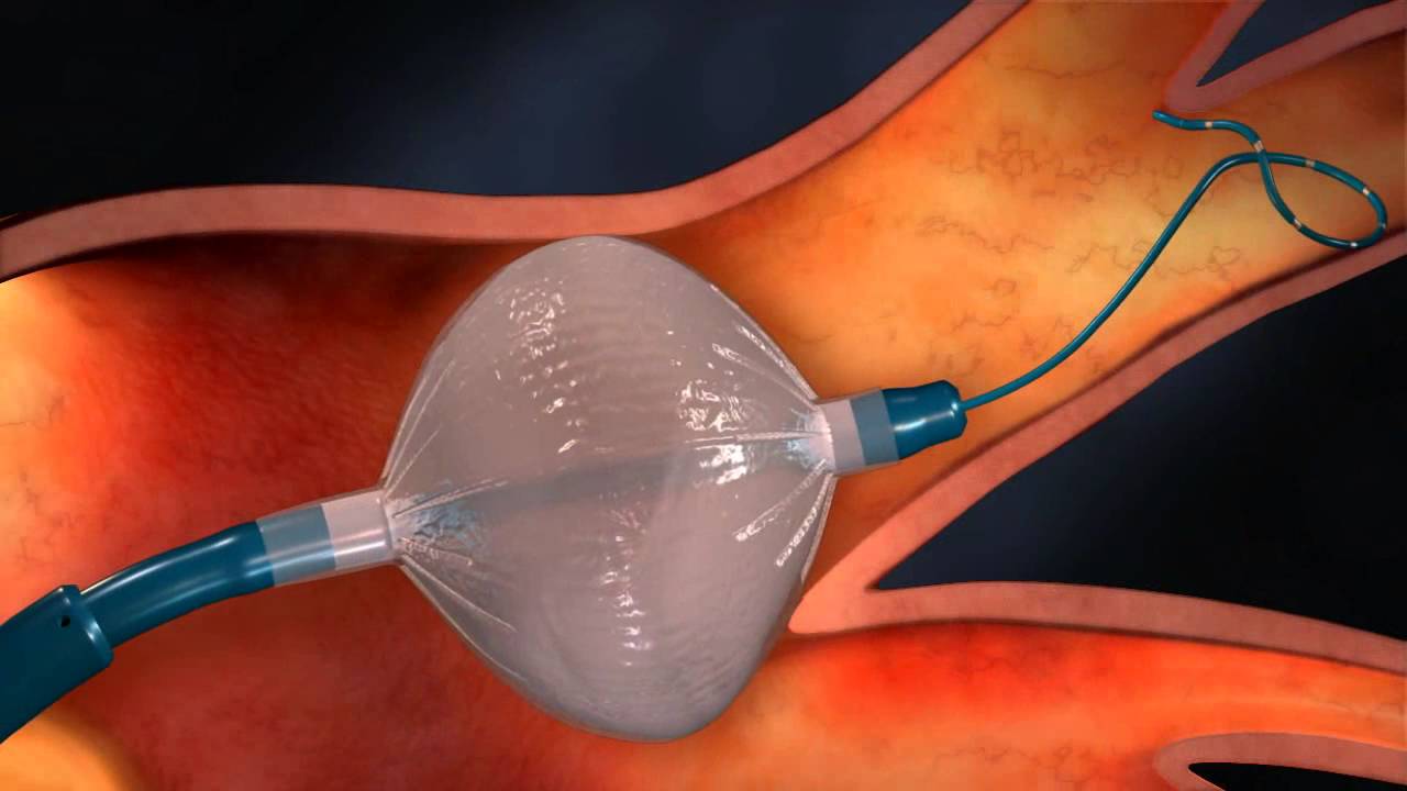 Cryoablation Animation