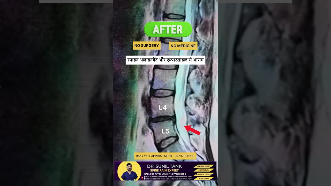 L4 L5 disc herniation treatment without surgery #drsuniltank #physiopoint #backpain #sciatica