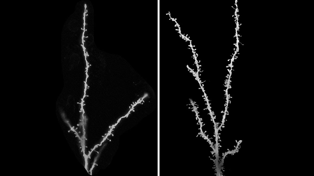 Children with Autism Have Extra Synapses in Brain