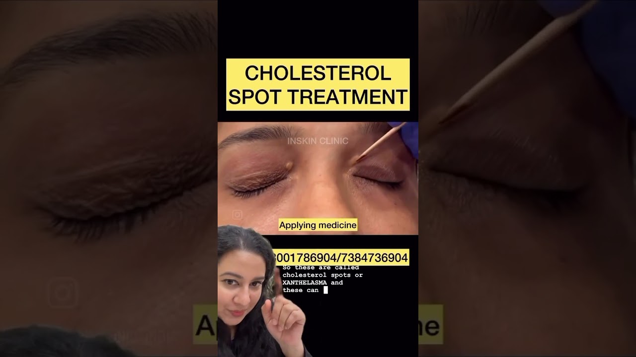 Xanthelasma treatment. #shorts #dermshorts