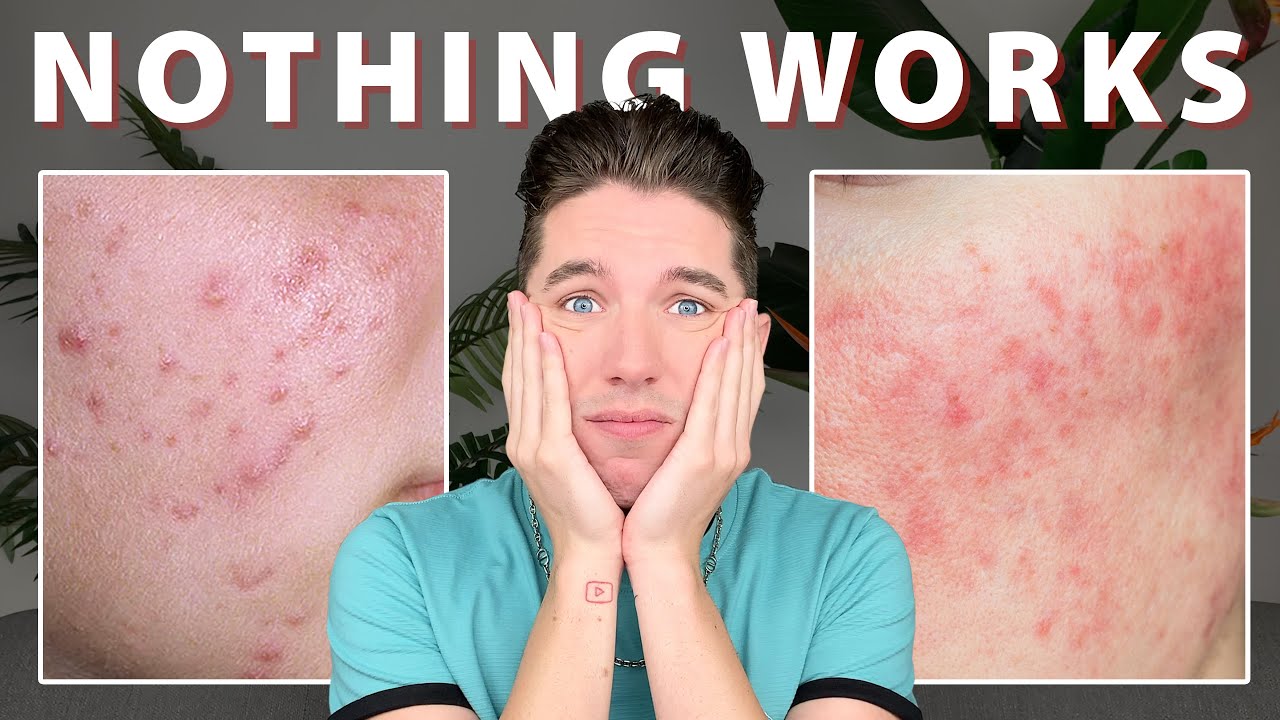 What if My Skin is Sensitive to Everything?