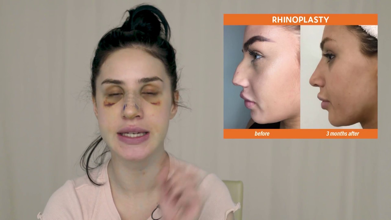 Dr. Montien Corrects Savannah's Dorsal Hump & Deviated Septum