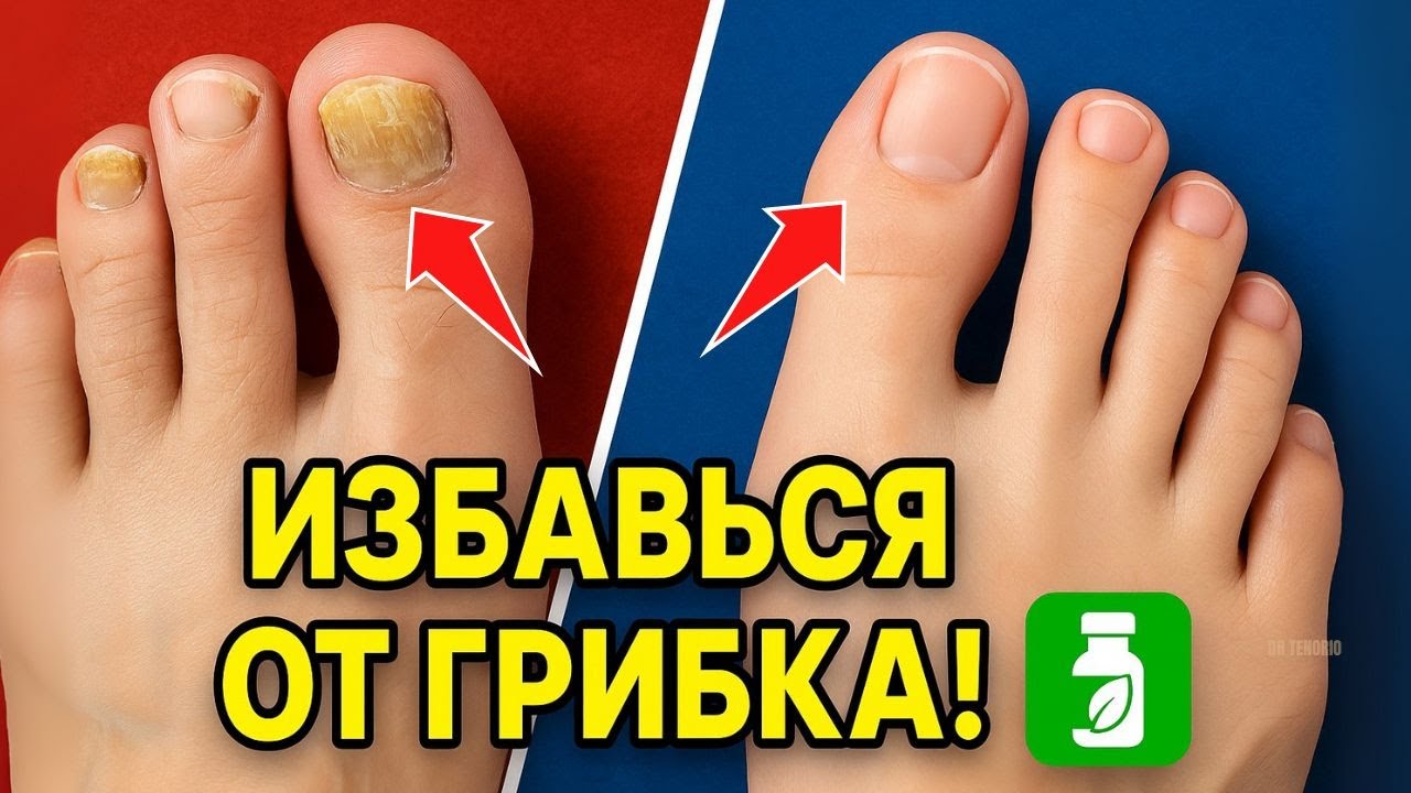 Грибок на ногтях и коже: КАК ИЗБАВИТЬСЯ НАВСЕГДА!