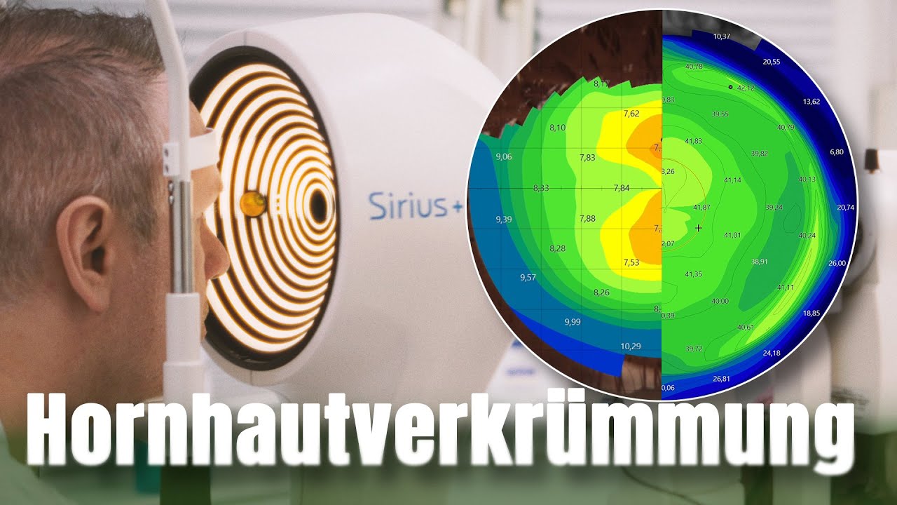 Hornhautverkrümmung erkennen: Von Astigmatismus bis Keratokonus