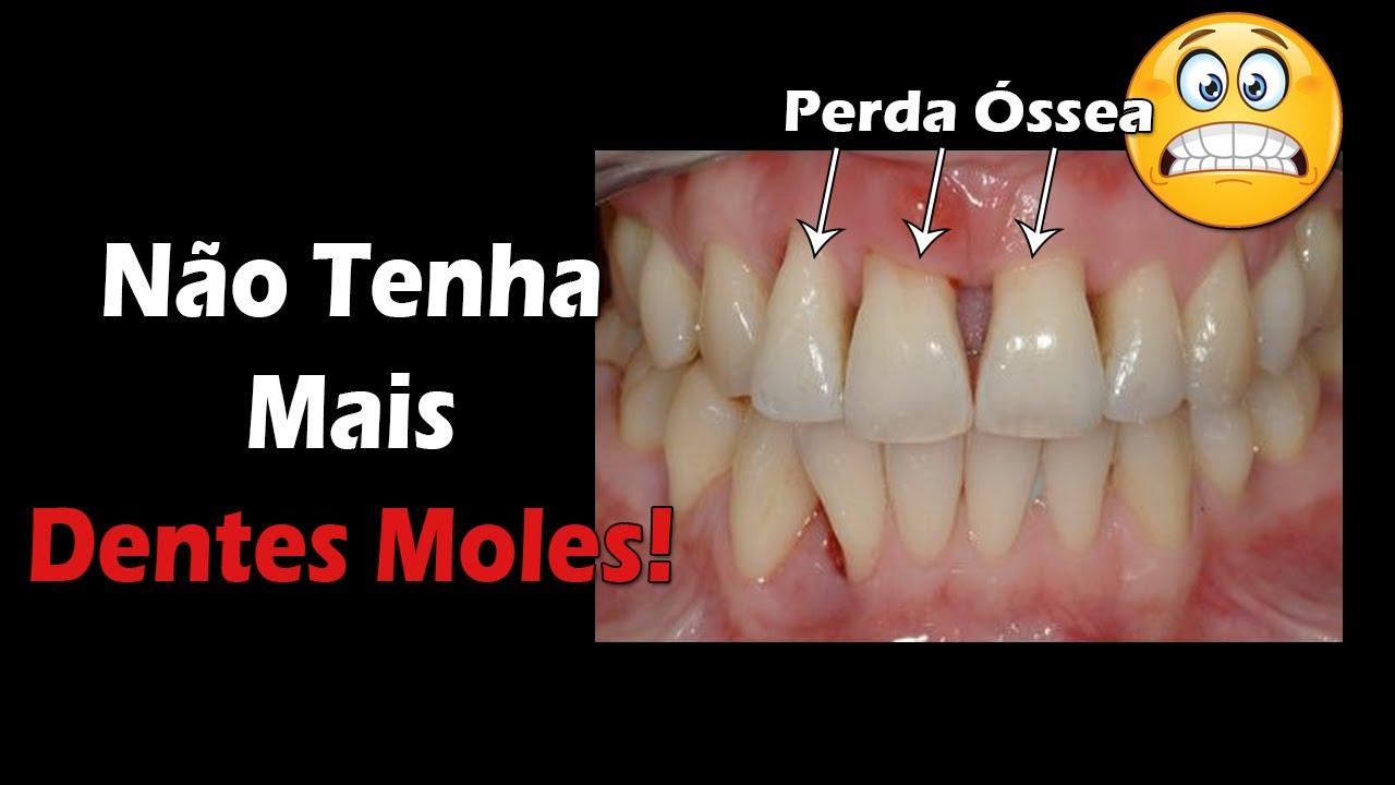 No More Loose Teeth - 3 Quick and Easy Tips - Periodontitis Can Be Cured