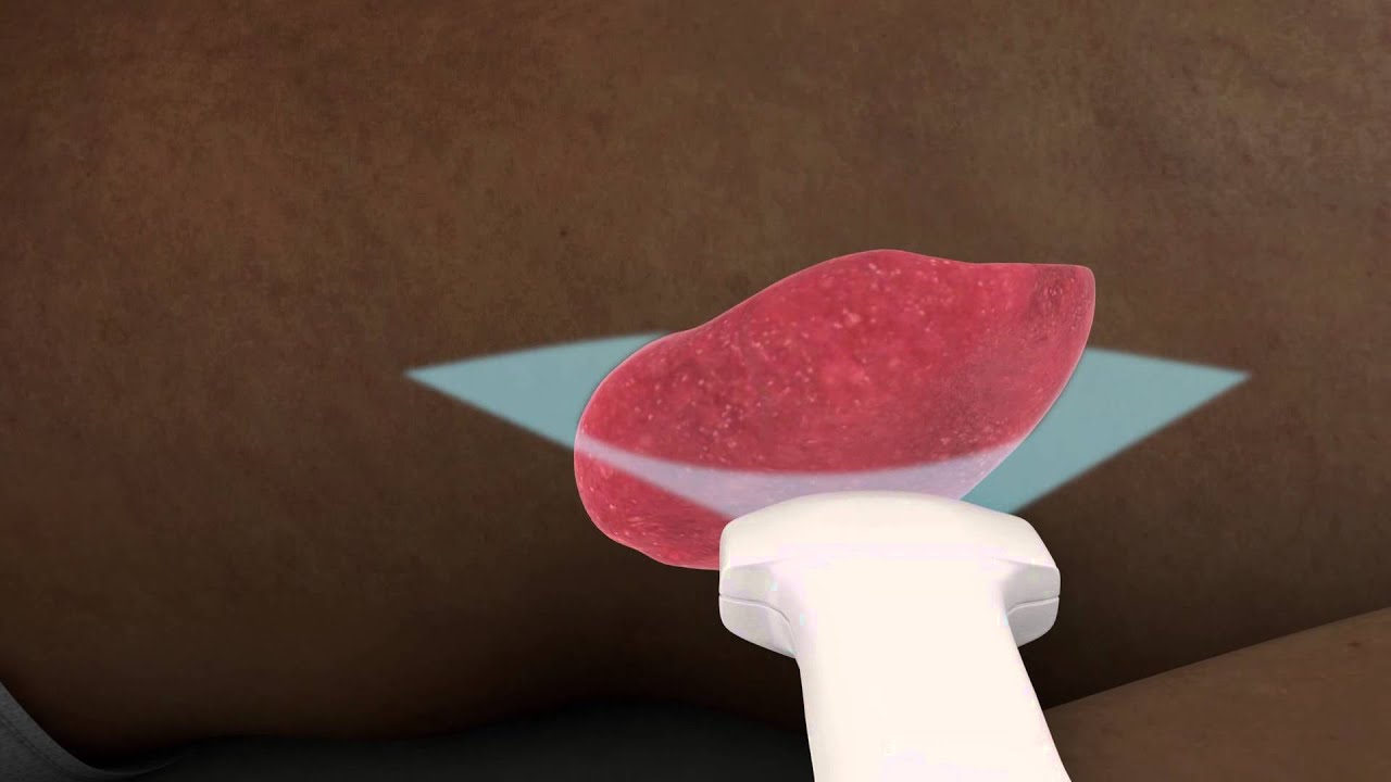Ultrasound of the Spleen