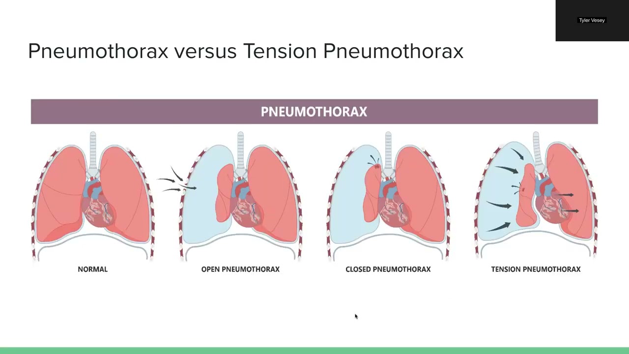 Management of Chest Trauma