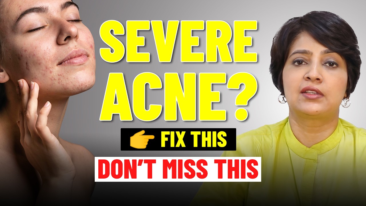A Complete Guide to Chemical Peels for Severe Acne Sufferers | Types of Chemical Peel | Dr. Dixit