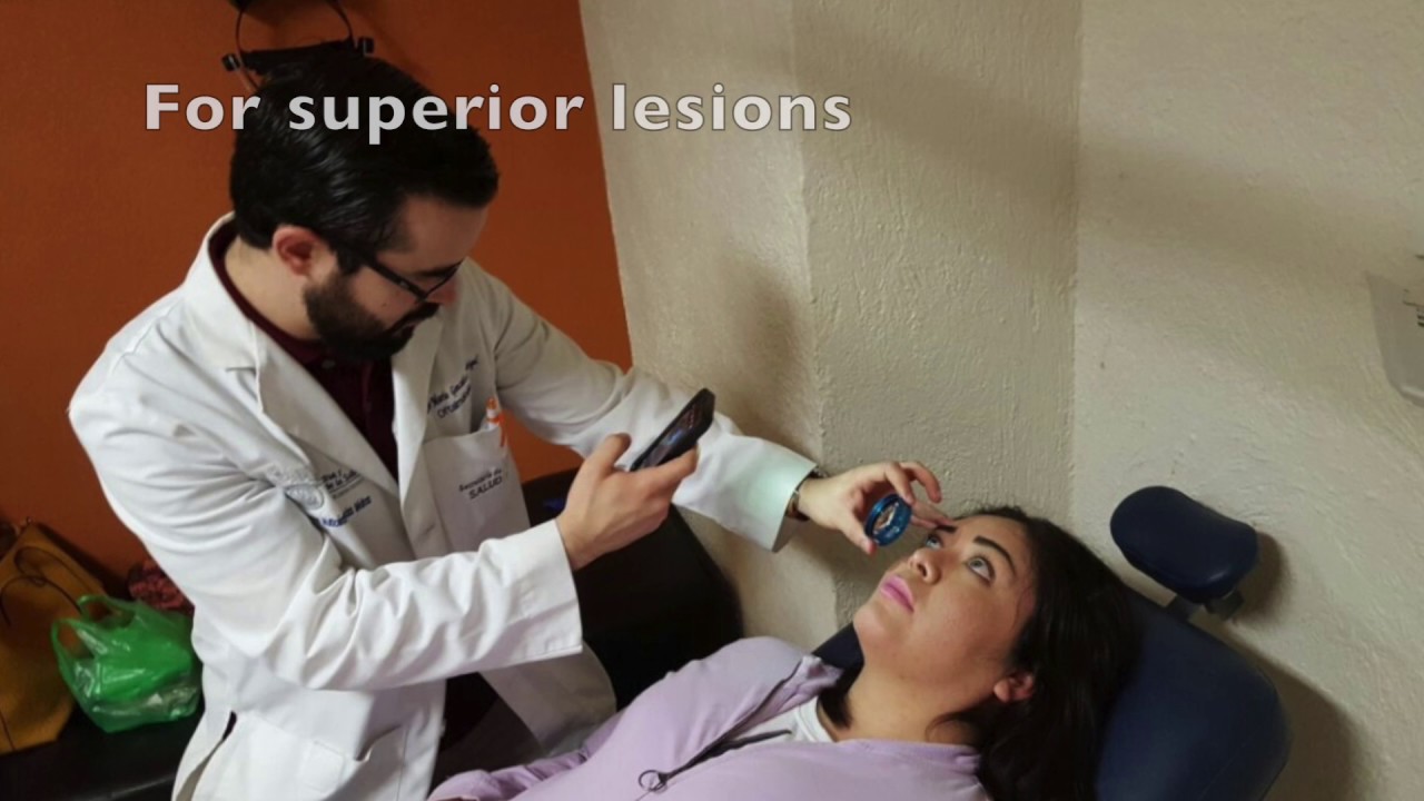 Peripheral fundus photography with a Smartphone-based technique