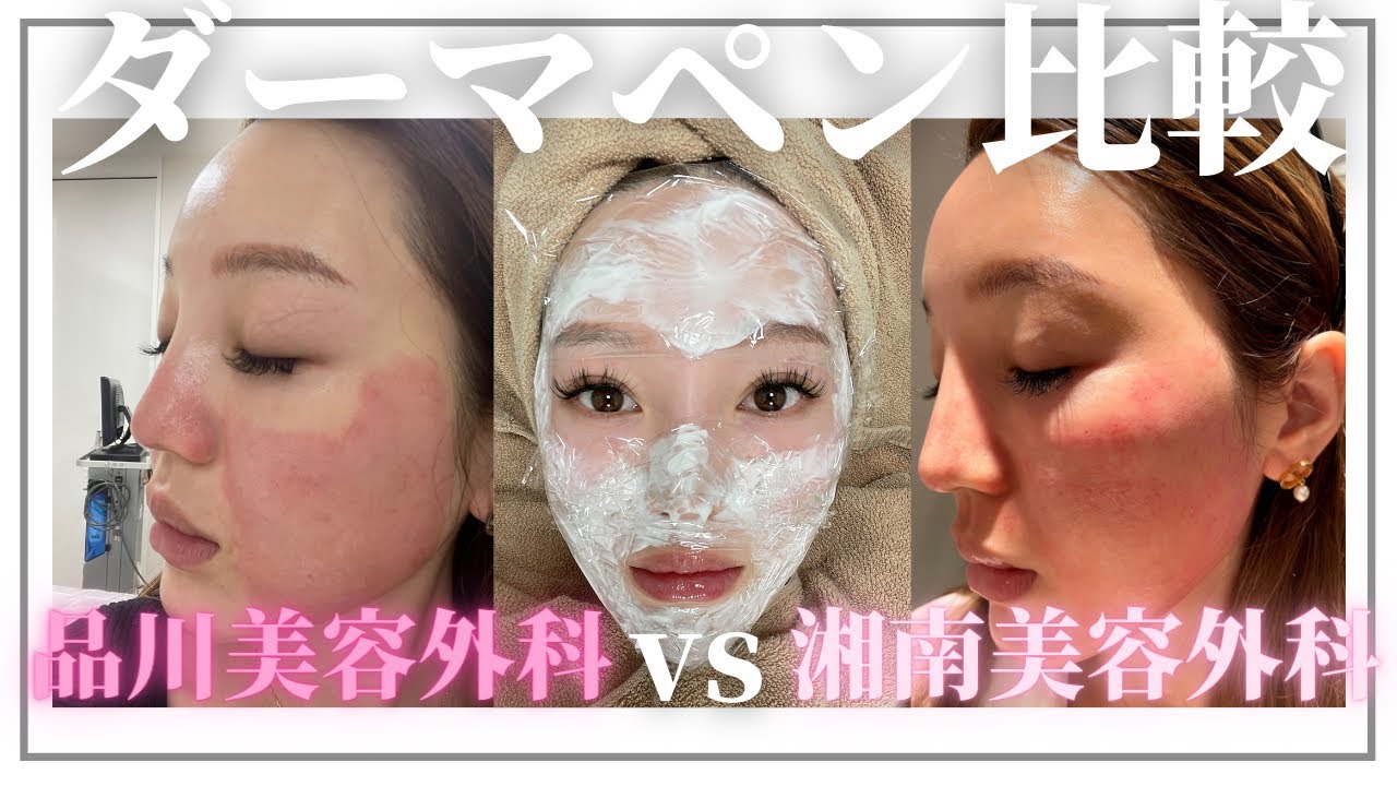 【ダーマペン比較】大手クリニック比較検証動画/結果に驚愕……