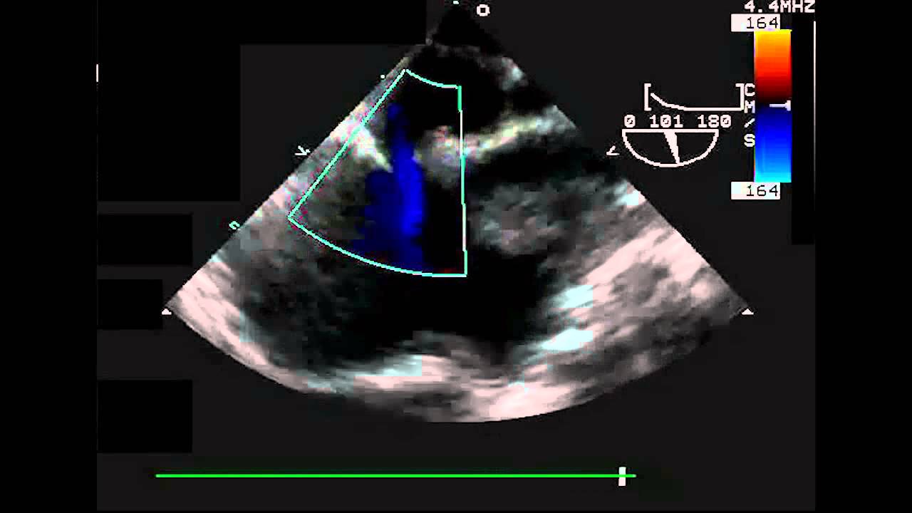 Secundum ASD TEE Bicaval View Color Doppler