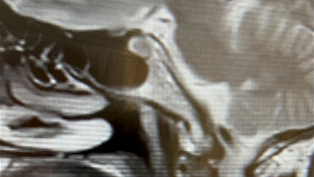 How to identify Thornwaldt Cyst on MRI