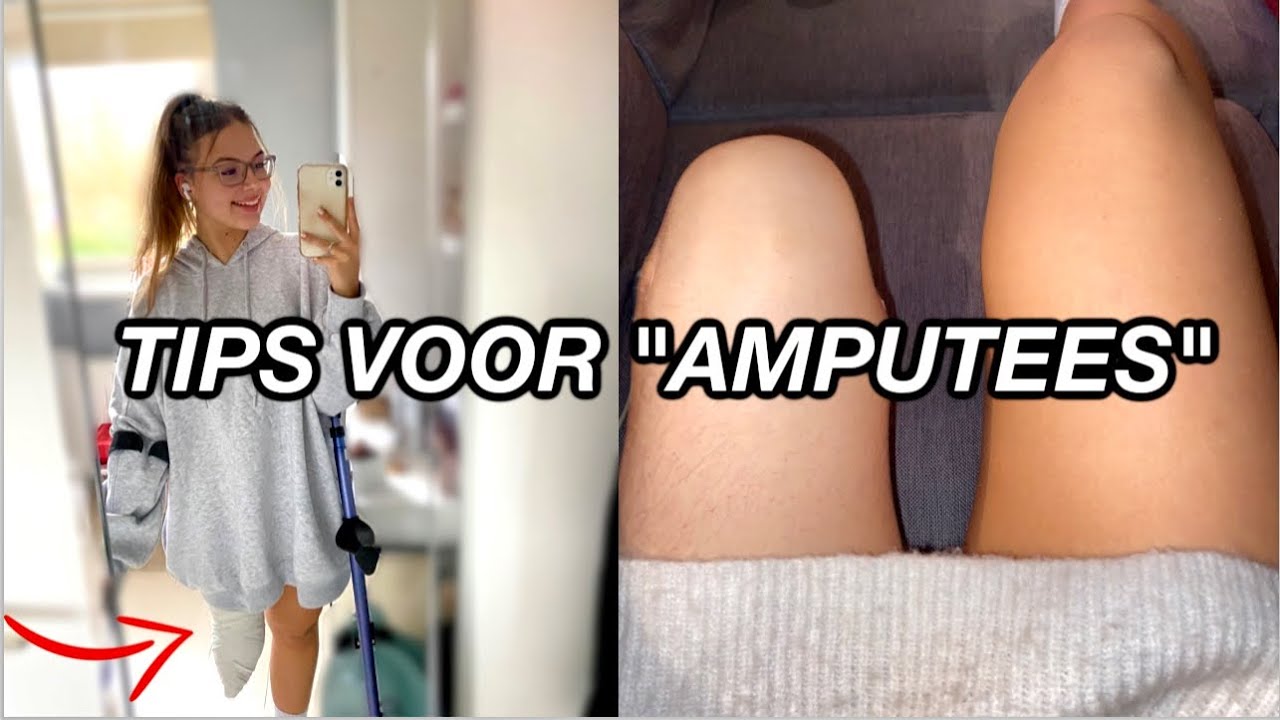 BESTE TIPS voor MENSEN met AMPUTATIE *ziekenhuis, revalidatieproces*