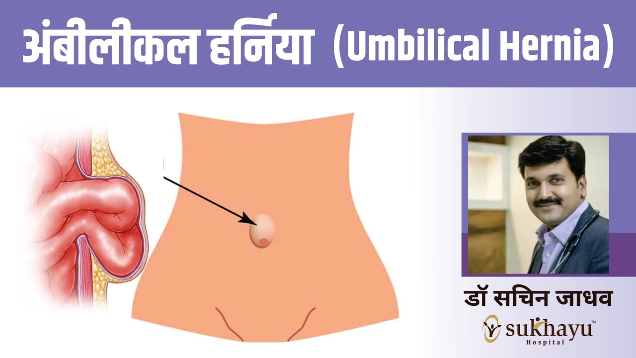 Umbilical Hernia Explained in Marathi
