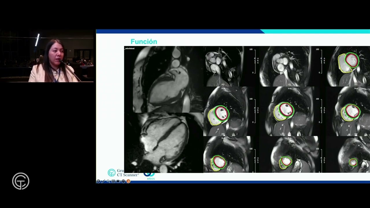 Resonancia Magnética en Cardio-Oncología