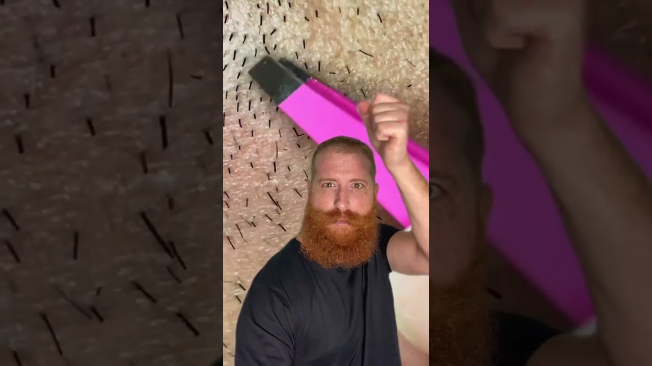 Pelo encravado na barba