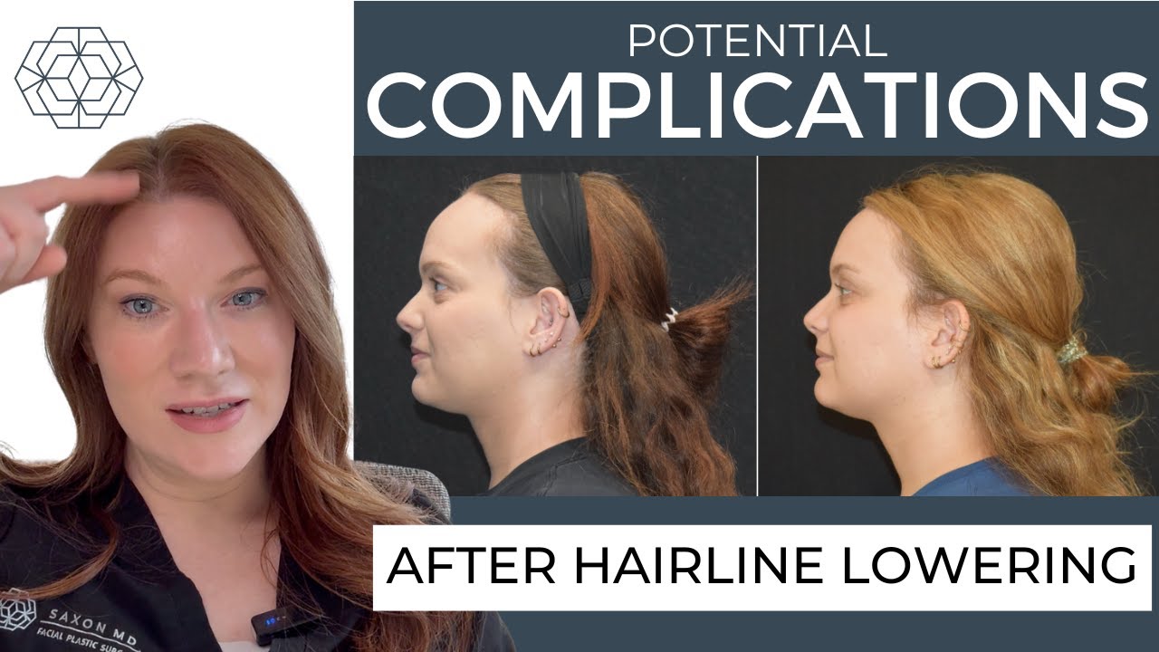 Hairline Lowering Complications Explained by Dr. Saxon | Forehead Reduction Surgery Risks & Benefits