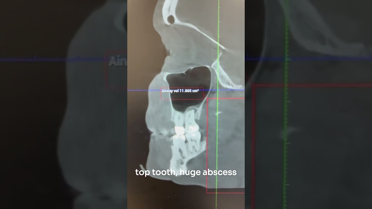 We found out why she was tired in her Cone Beam CT Scan #shorts