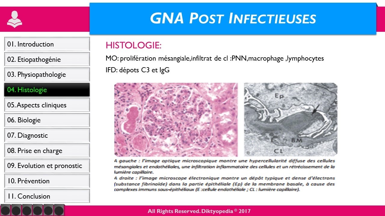 Glomérulonéphrites Aigues Post Infectieuses (GNA)
